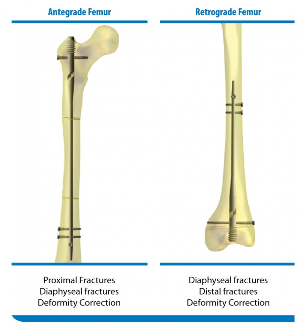 Modified fixation for periprosthetic supracondylar femur fractures: Two  case reports and review of the literature