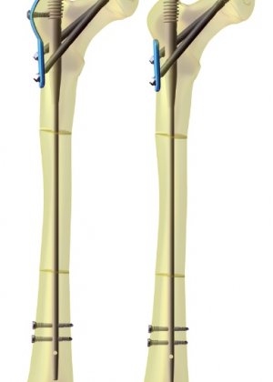 Pega Medical