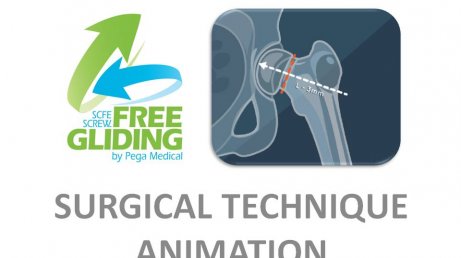 Pega Medical