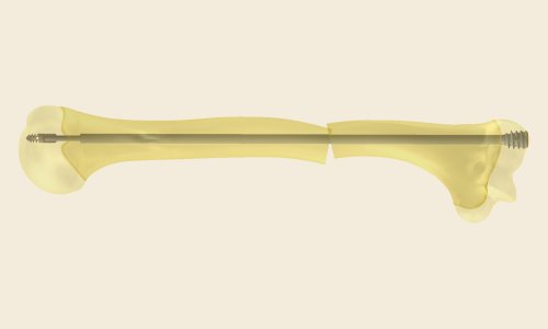 Article Published by JPO: 'Retrograde Application of Humerus Fassier-Duval Rod in Osteogenesis Imperfecta'