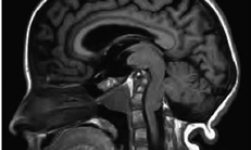 Are Fassier-Duval Rods at Risk of Migration in Patients Undergoing Spine Magnetic Resonance Imaging?