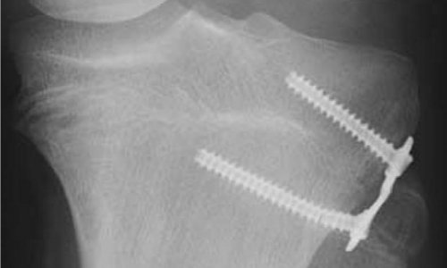HINGE PLATE™ – Radiographic Results and Complications of 3 Guided Growth Implants