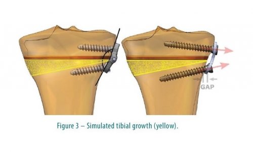 Hinge Plate™ – Not Thicker but Stronger! 
