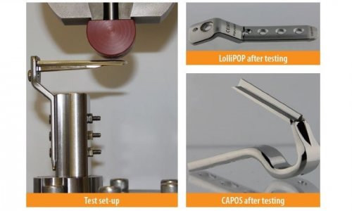 BIOMECHANICAL PERFORMANCE OF A MODULAR BLADE-PLATE