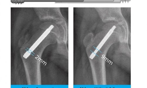 Growth & Remodeling Potential in a Non-Fusion Approach to SCFE