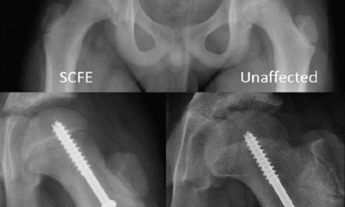 Abstract – Growth friendly fixation strategy to prevent proximal femoral deformity