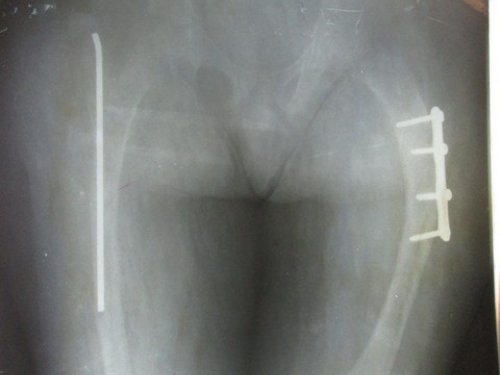 Pega Medical