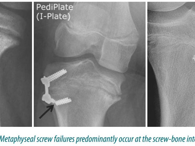 Plate Failures